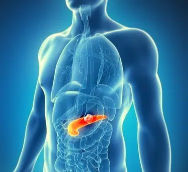 Tumore Al Pancreas